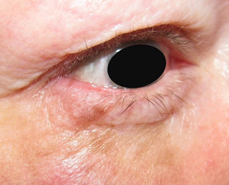 File:Eyelid Melanoma.jpg