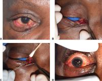 Repair of right lower eyelid laceration involving the canaliculus. A, Avulsion injury of the right lower eyelid. B, Lacrimal probe placed demonstrating the canalicular involvement. C, Lacrimal stent placement through the lacerated eyelid. D, Immediate postoperative result after reconstruction.