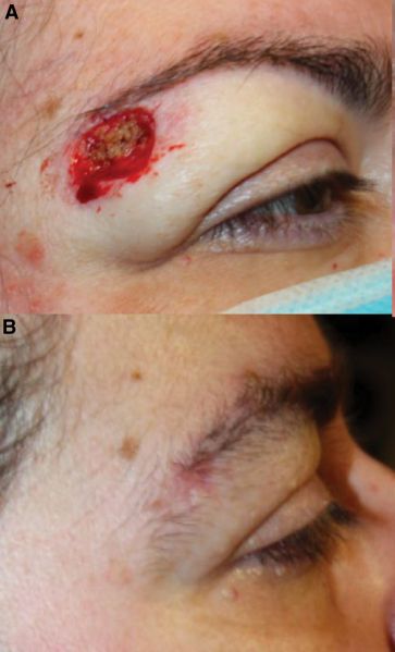 File:Figure 2 SCCA Left Brow.jpg