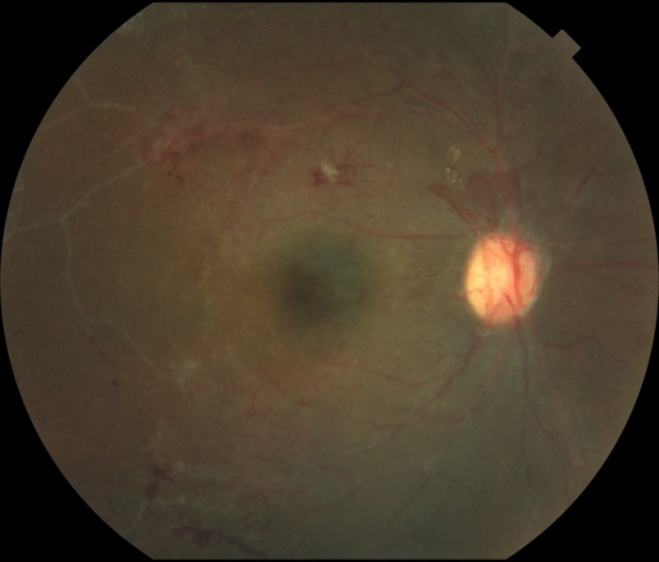 Idiopathic Retinitis, Vasculitis, Aneurysms, and Neuroretinitis (IRVAN ...