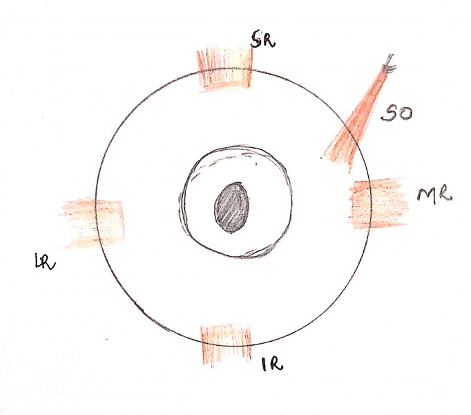 File:Peter's procedure.jpg