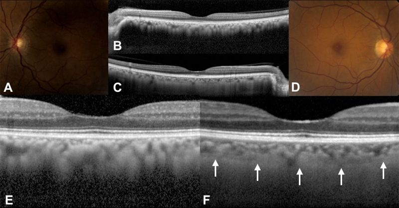 File:Unilateral melanocytosis.jpg
