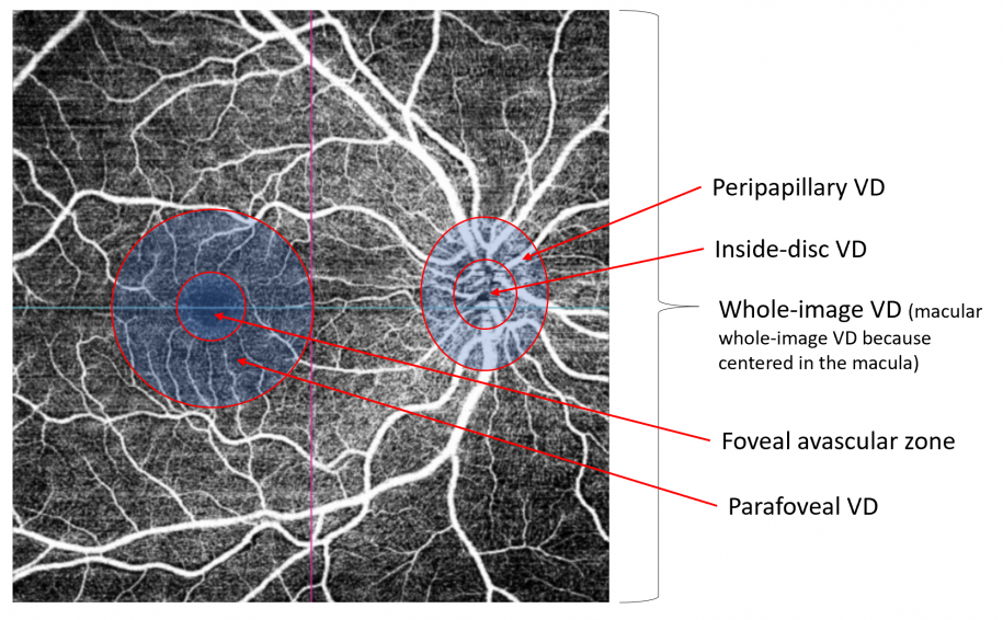 OCT-Angiography and Glaucoma - EyeWiki
