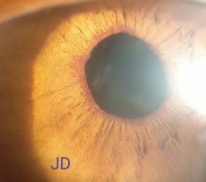 Figure 1: Rubeosis Iridis without Ectropion Uvea