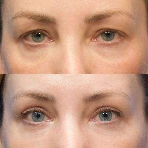 Example of upper blepharoplasty illustrating correction of heavy upper eyelids and refreshed eye appearance. Images courtesy of Dr. Shannon S. Joseph