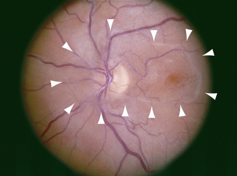 File:VMT fundus photo from AAO.jpg