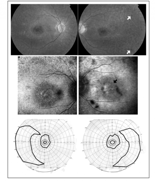 File:Fundus FAF-Goldmann RP.png