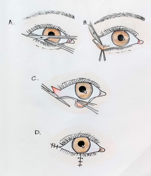 File:5 Sahil Canthotomy and Cantholysis.jpg