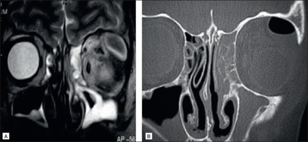 Invasive Fungal Infections of the Orbit and Sinuses - EyeWiki
