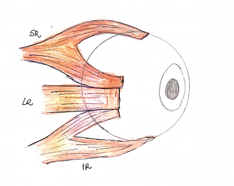 File:Hummelsheim's procedure.jpeg