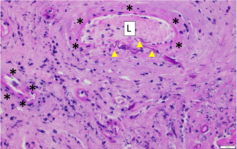 File:Histo muco angioinvasive CMPP.png
