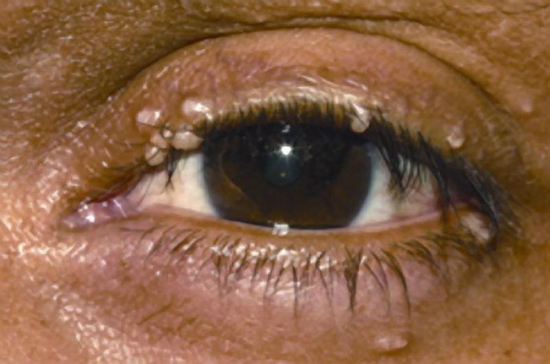 File:Mollescum.jpg