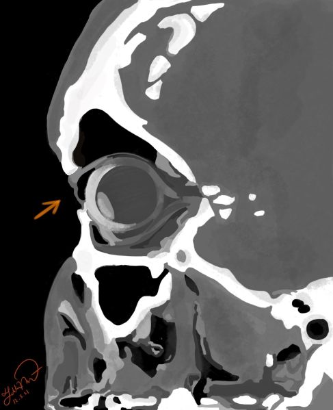 File:Silent Brain Syndrome CT.jpg