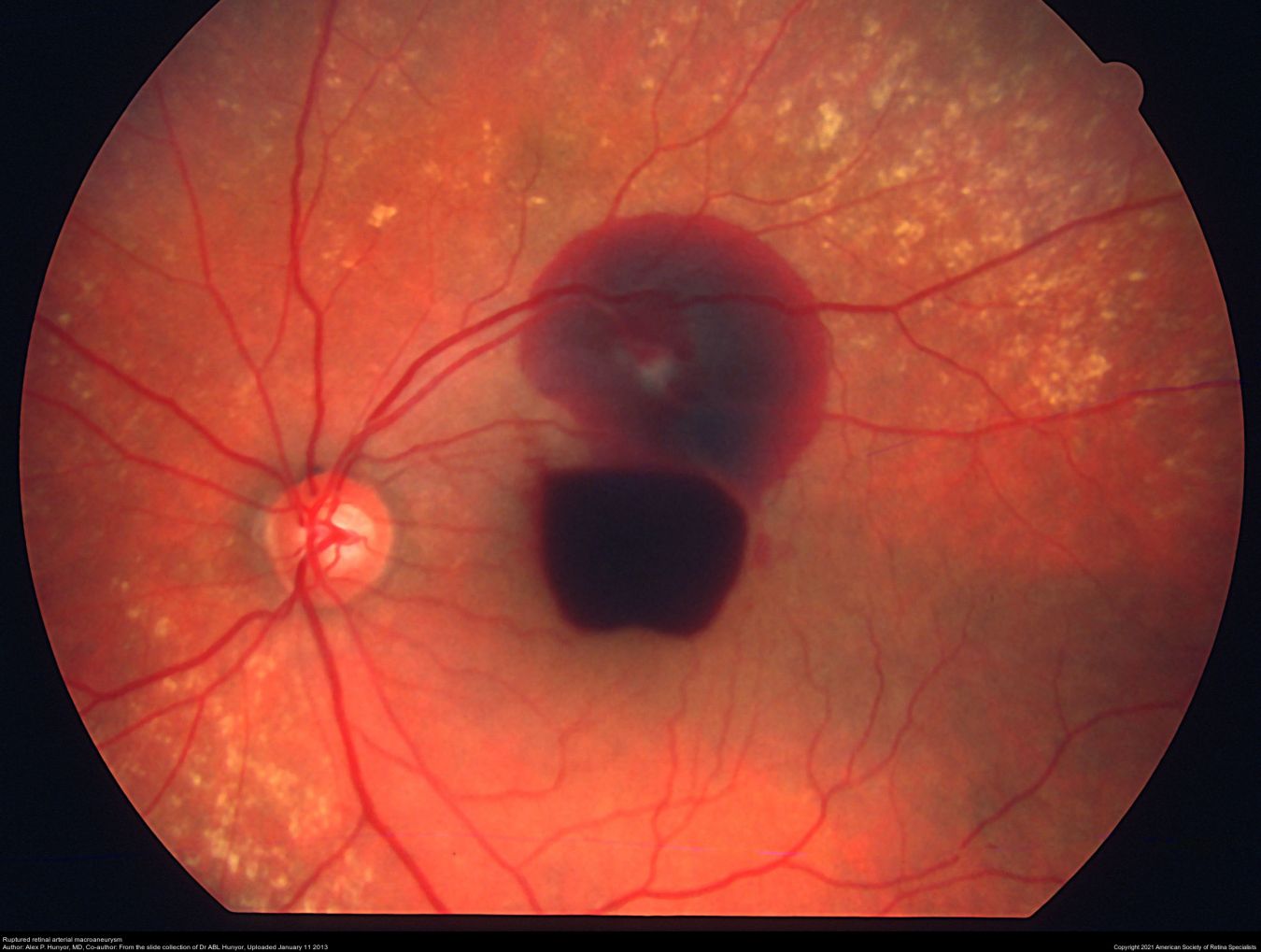 macroaneurysm-eyewiki