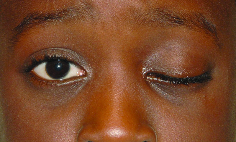 File:Amblyogenic ptosis,.png