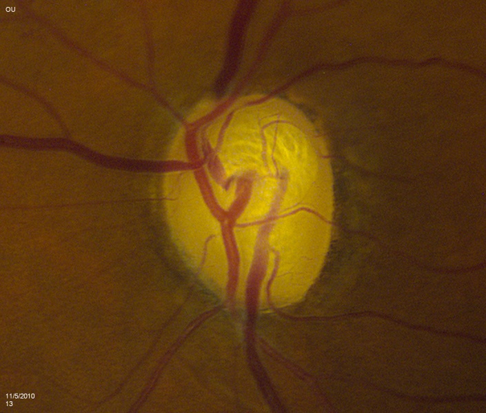 File:Glaucoma6.JPG