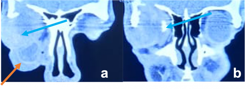 File:Adenocystic Carcinoma.png