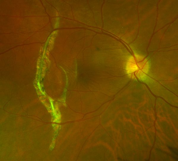 Choroidal Rupture - EyeWiki