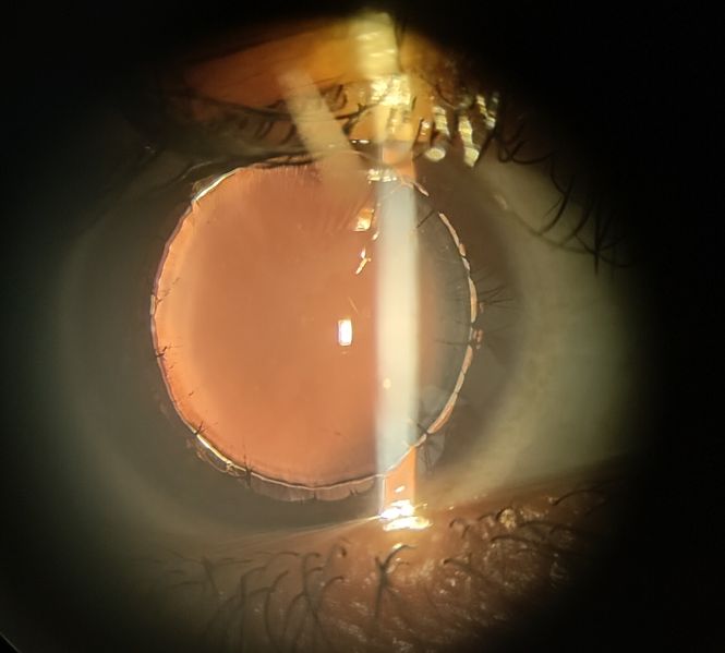 File:Microspherophakia with posterior synechiae1.jpeg
