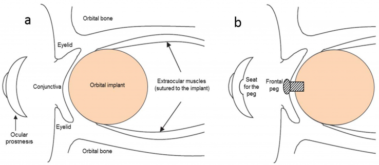 History of Oculoplastics - EyeWiki