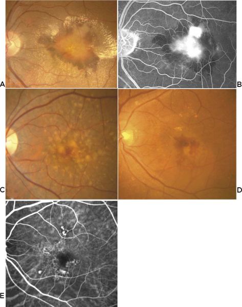 File:Age-related Macular Degeneration-1.jpg