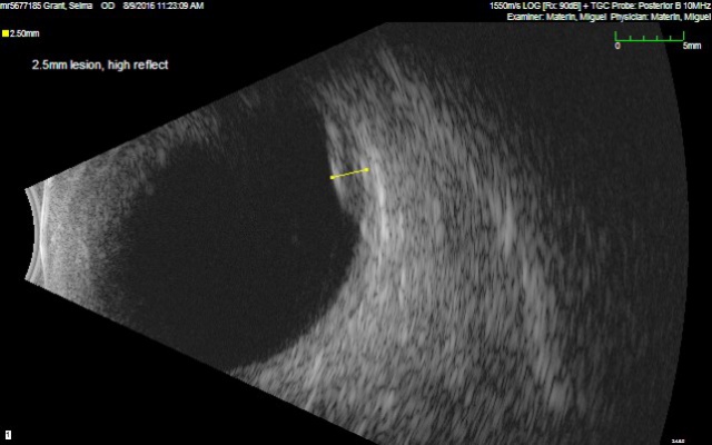 Peripheral Exudative Hemorrhagic Chorioretinopathy - EyeWiki