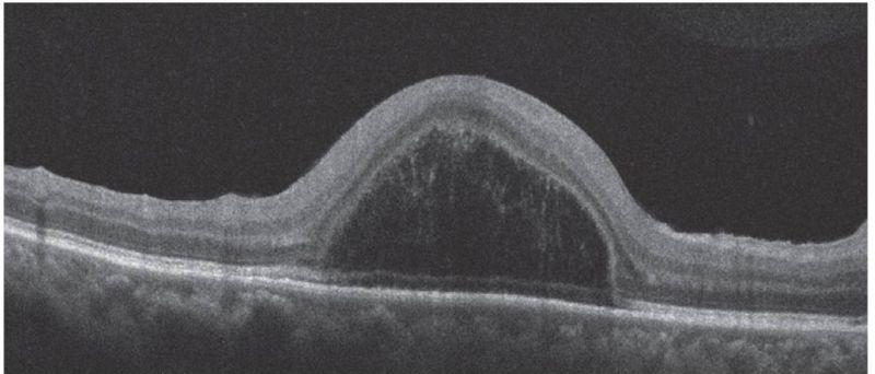 File:Bacillary layer detachment .jpg
