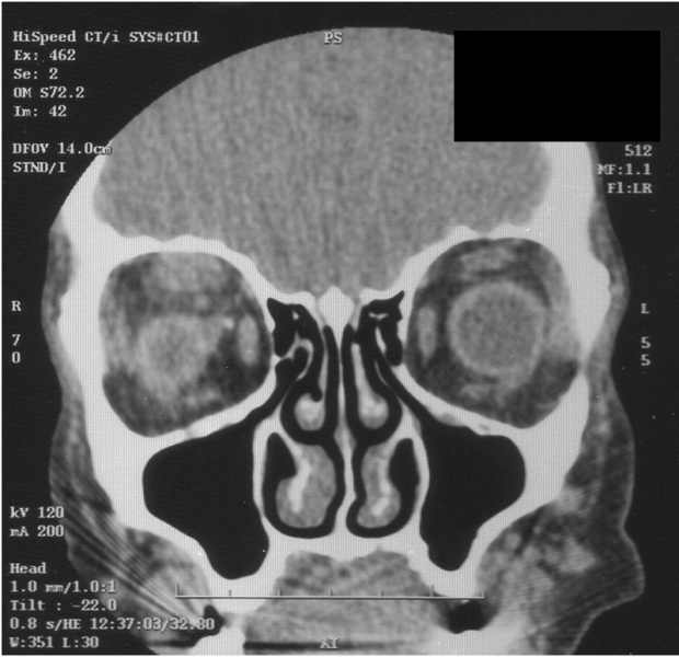 File:CT Ptosis Amyloidosis.jpg