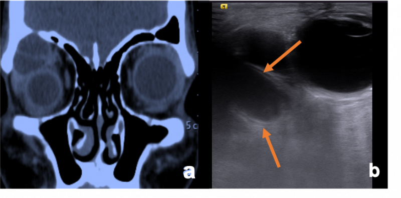 File:Hydatid cyst.png