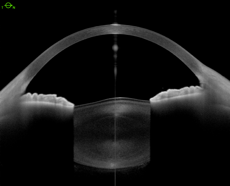 File:Lenticone OCT.png