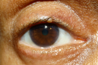 Basal cell carcinoma