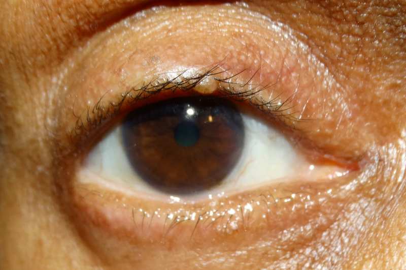 File:Basal Cell Carcinoma African American.png