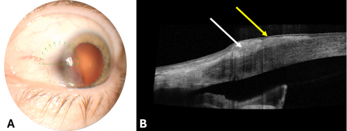 Salzmann Nodular Degeneration - EyeWiki