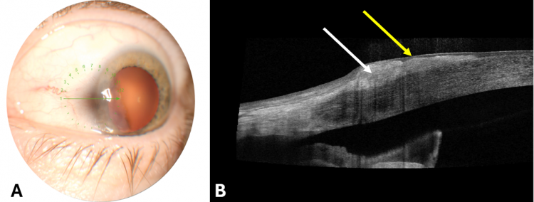 Salzmann Nodular Degeneration - EyeWiki