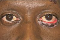 Photograph demonstrating a variably pigmented placoid lesion with irregular borders diffusely involving the left lower eyelid. Generalized eyelid thickening is present.