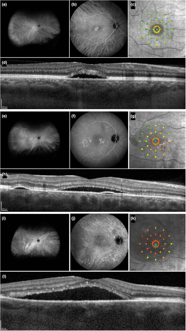 Central Serous Chorioretinopathy - EyeWiki