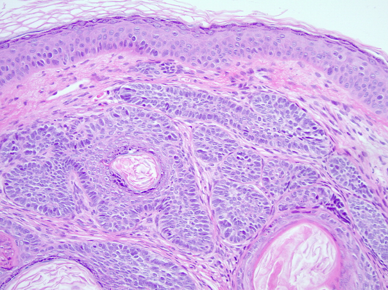 File:Trichoepithelioma Histology.png