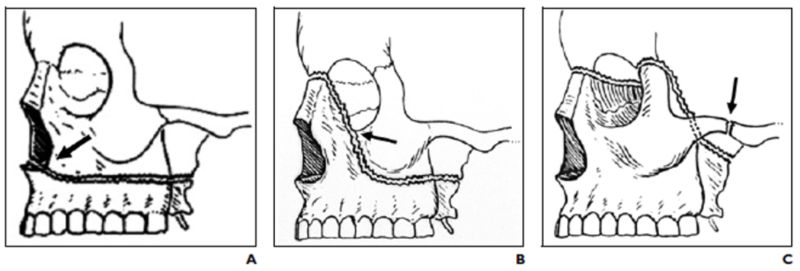 File:Le Fort Fractures I-II-III.png