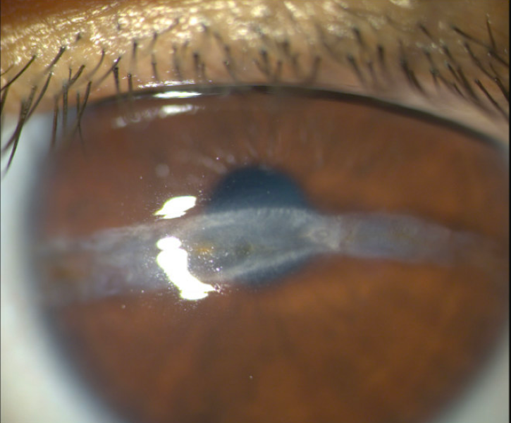 File:Linear Interstitial Keratitis .png