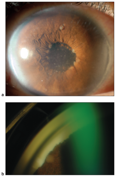 File:Hispanic patient with sarcoidosis.png