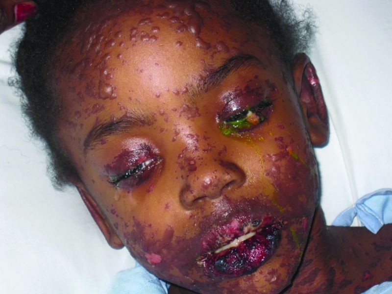 File:Stevens-Johnson syndrome.jpg
