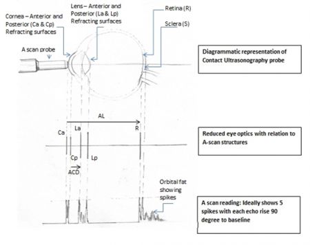 Biometry for Intra-Ocular Lens (IOL) Power Calculation - EyeWiki