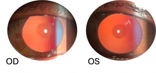 Coppock cataract (hereditary pulverulent cataract (Coppock-type)): Retroillumination slit-lamp photographs of both eyes (OD and OS) demonstrating bilateral, symmetric, central pulverulent lens opacities. A 40-year-old asymptomatic woman was referred for evaluation of suspected lens opacity. Best-corrected visual acuity was 6/6 in both eyes. The opacities are centrally located, well circumscribed, and exhibit a fine powder-like appearance, consistent with a hereditary pulverulent cataract (Coppock-type). A positive family history of early-onset cataract was reported. Given the absence of visual symptoms or functional impairment, conservative management with observation was elected. (Image courtesy of Joobin Khadamy, MD, FEBOS-CR)