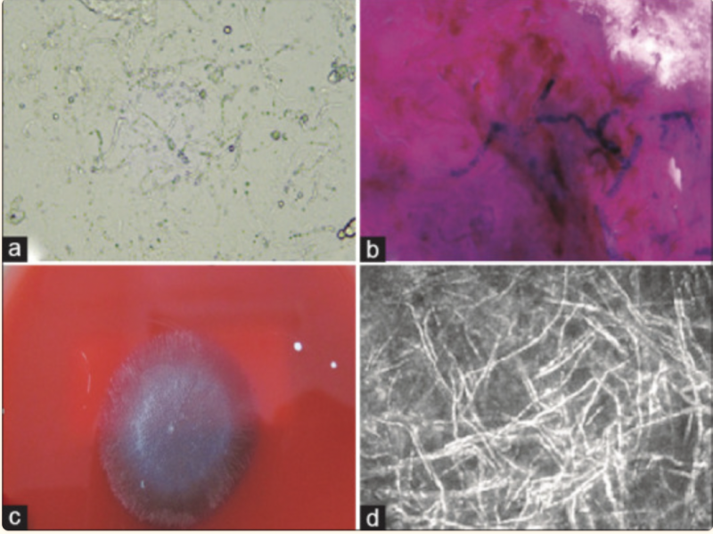 File:Figure 6 Eyewiki.png