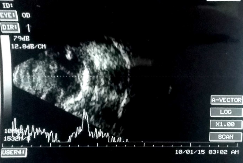 File:Koushik phthisis calcification.jpg