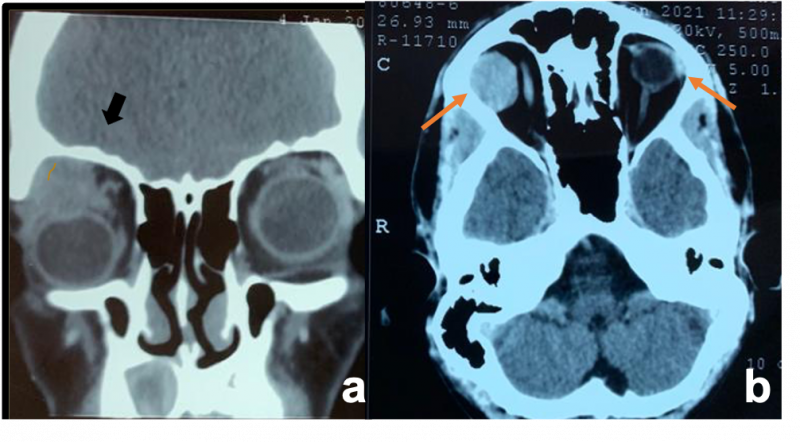 File:Pleomorphic Adenoma.png