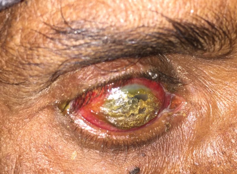 File:Spheroidal Degeneration.jpg