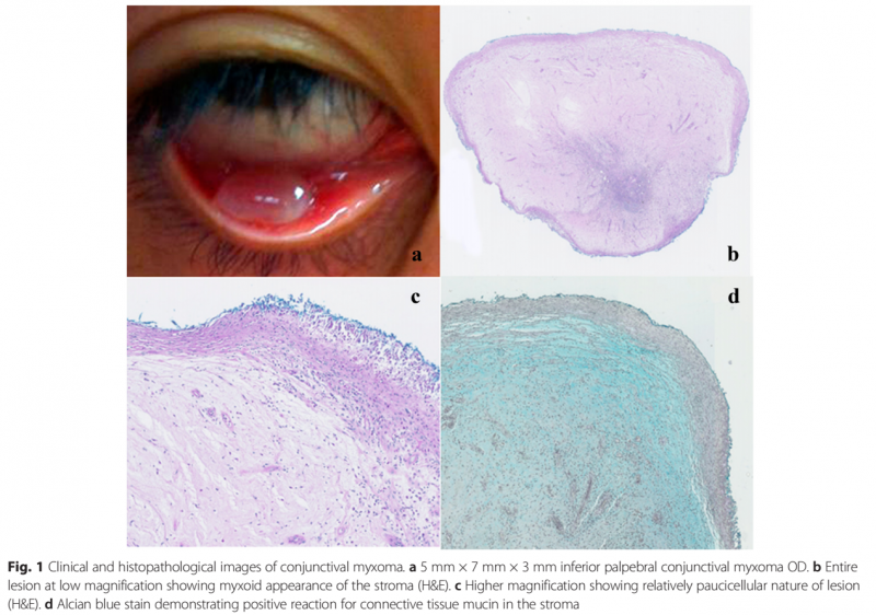 File:Conjunctival Myxoma.png