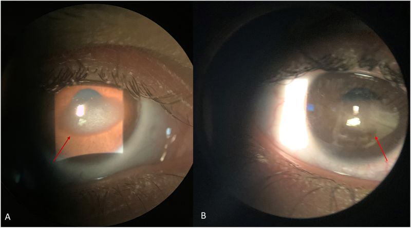 File:Corneal opacification SSS.jpg