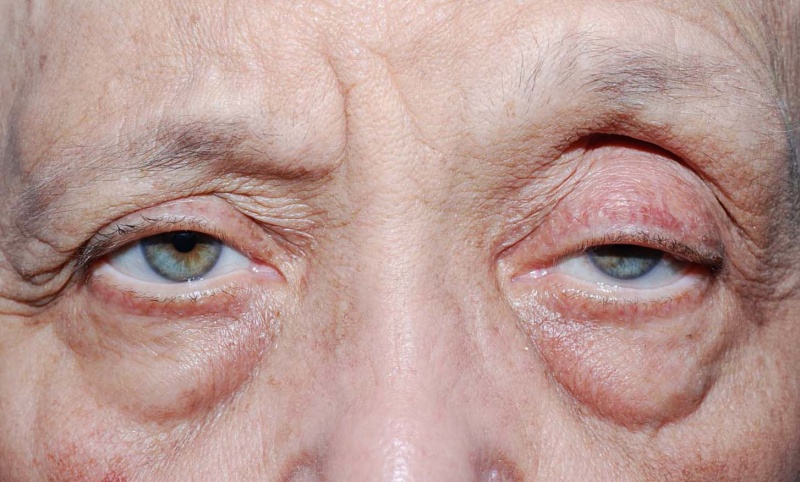 File:Involutional blepharoptosis greater in LUL.jpg